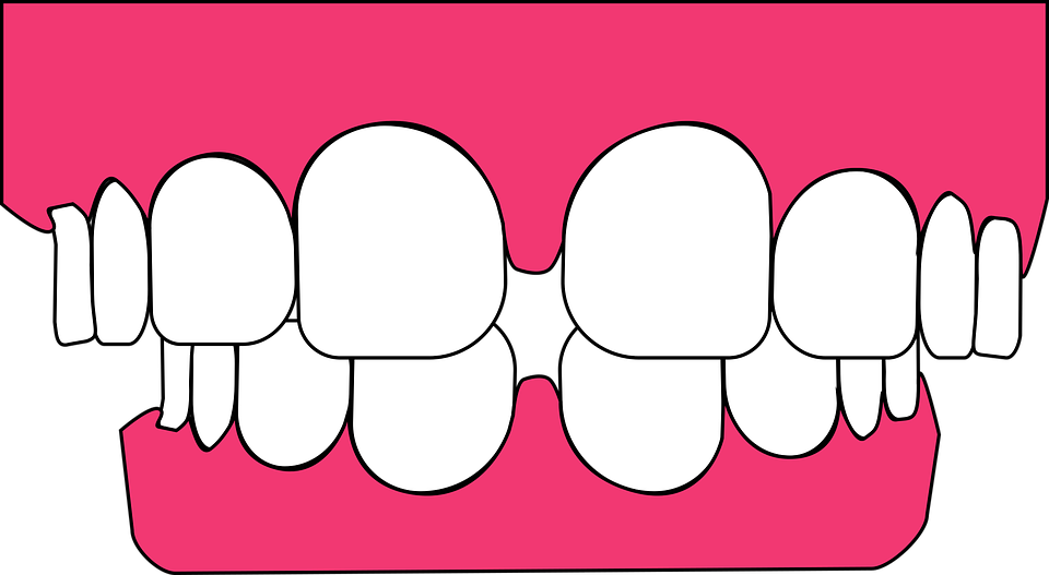 Bruxisme : Grincez-vous des dents ou serrez-vous les dents ?