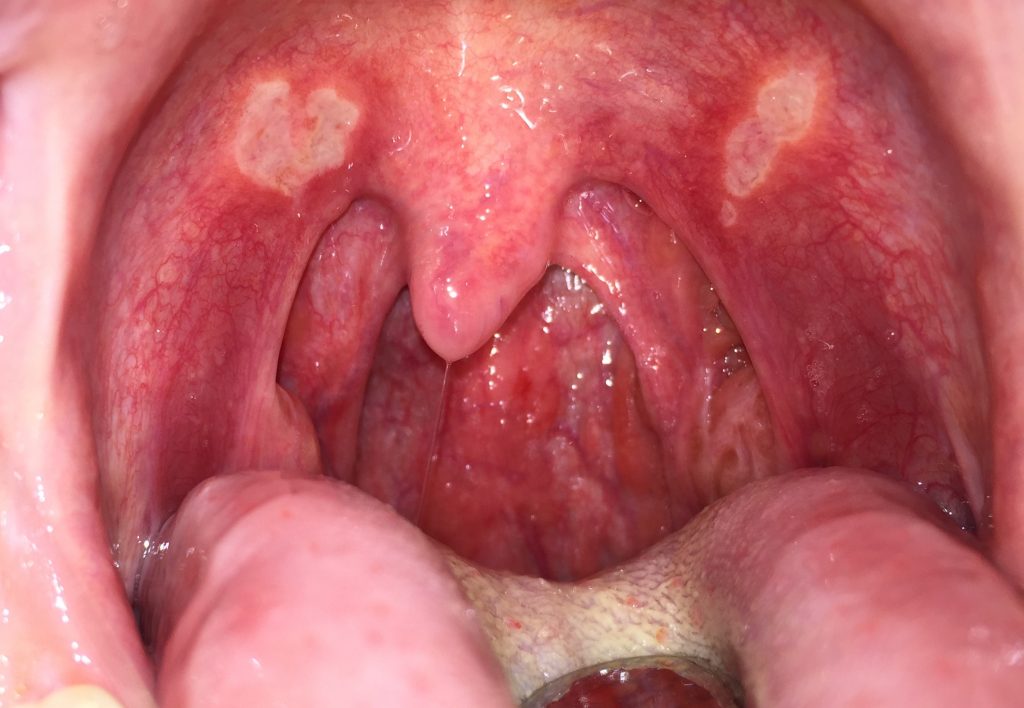 Papillomavirus bouche et gorge
