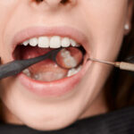 Examen dentaire avant pose onlay